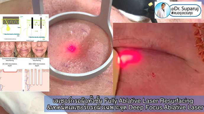 เลเซอร์กรอผิวทั้งชั้น Fully Ablative Laser Resurfacing &เทคนิคเลเซอร์กรอผิวเฉพาะจุด Deep Focus Ablative Laser เลเซอร์กรอผิวทั้งชั้น Fully Ablative Laser Resurfacing &เทคนิคเลเซอร์กรอผิวเฉพาะจุด Deep Focus Ablative Laser