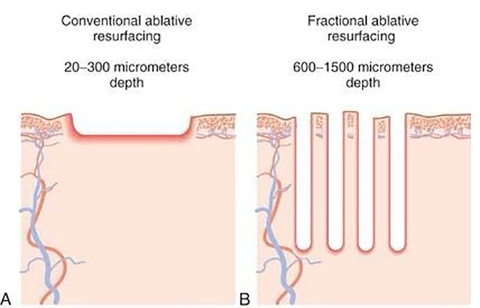 เลเซอร์กรอผิวทั้งชั้น Fully Ablative Laser Resurfacing &เทคนิคเลเซอร์กรอผิวเฉพาะจุด Deep Focus Ablative Laser