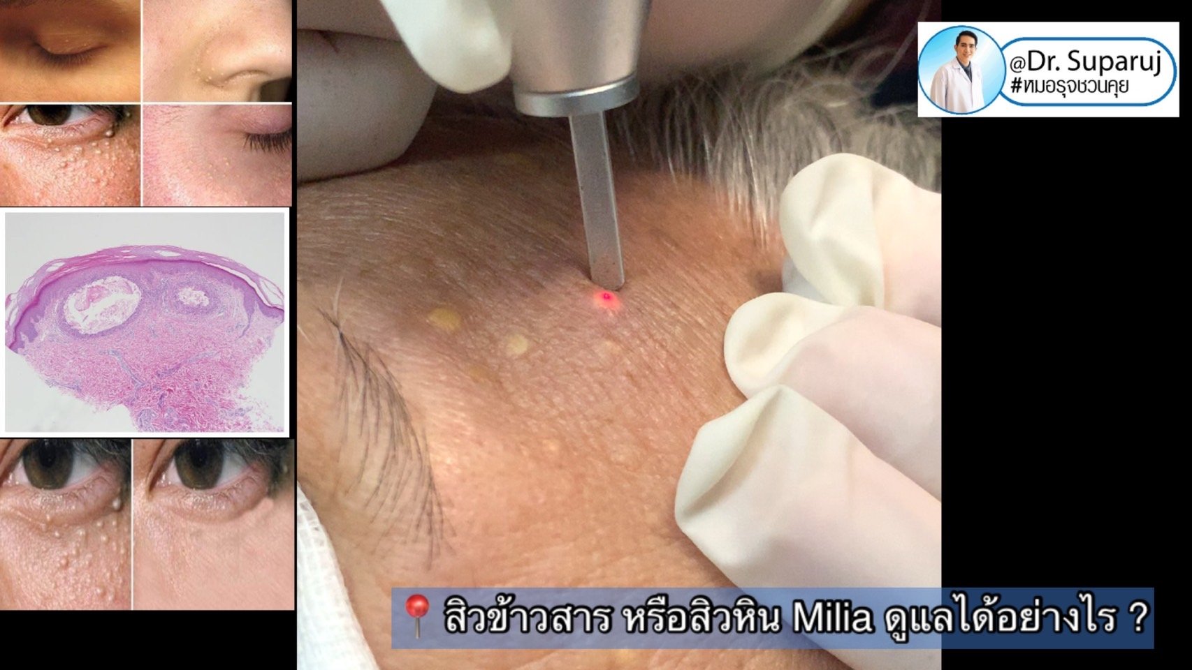 สิวข้าวสาร หรือสิวหิน Milia ดูแลได้อย่างไร ? สิวข้าวสาร หรือสิวหิน Milia ดูแลได้อย่างไร ?