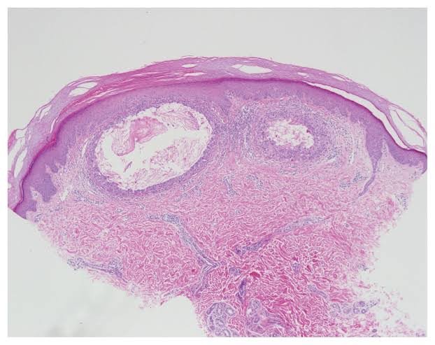 สิวข้าวสาร หรือสิวหิน Milia ดูแลได้อย่างไร ? สิวข้าวสาร หรือสิวหิน Milia ดูแลได้อย่างไร ?