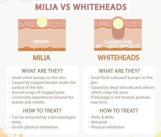 สิวข้าวสาร หรือสิวหิน Milia ดูแลได้อย่างไร ? สิวข้าวสาร หรือสิวหิน Milia ดูแลได้อย่างไร ?