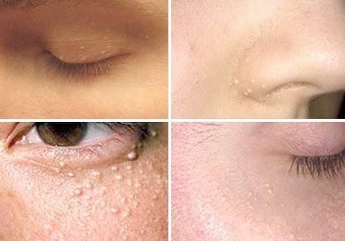 สิวข้าวสาร หรือสิวหิน Milia ดูแลได้อย่างไร ? สิวข้าวสาร หรือสิวหิน Milia ดูแลได้อย่างไร ?