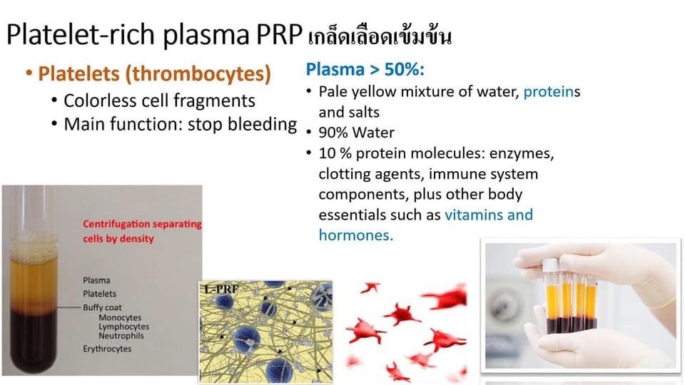 แนะนำเทคนิคดูแลหลุมสิว ep. 12 เกล็ดเลือดเข้มข้น Platelet-rich plasma (PRP)ในการดูแลรักษาหลุมสิว PRP in Acne Scar Treatment (อย่างละเอียดครับ)
