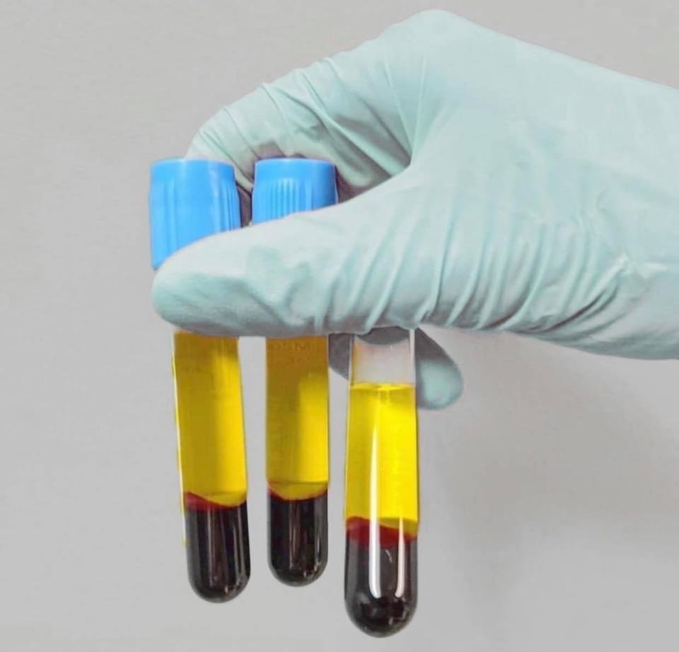 แนะนำเทคนิคดูแลหลุมสิว ep. 12 เกล็ดเลือดเข้มข้น Platelet-rich plasma (PRP)ในการดูแลรักษาหลุมสิว PRP in Acne Scar Treatment (อย่างละเอียดครับ) แนะนำเทคนิคดูแลหลุมสิว ep. 12 เกล็ดเลือดเข้มข้น Platelet-rich plasma (PRP)ในการดูแลรักษาหลุมสิว PRP in Acne Scar Treatment (อย่างละเอียดครับ)