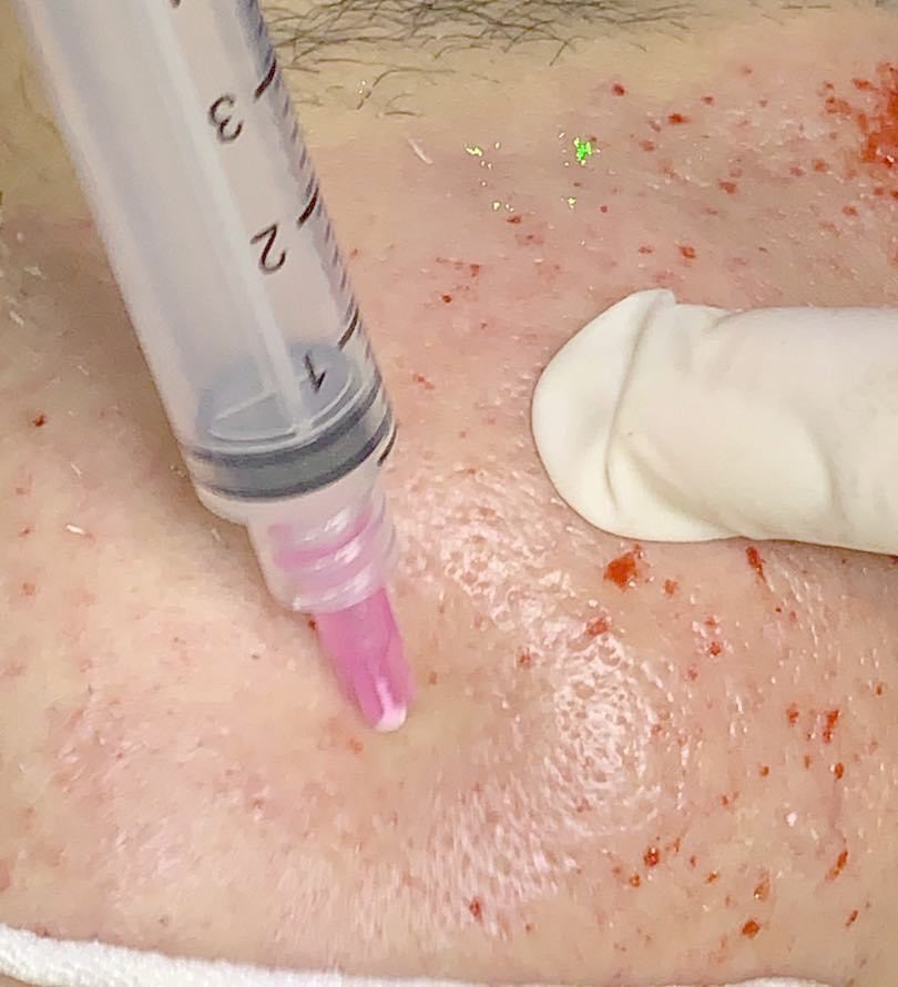 แนะนำเทคนิคดูแลหลุมสิว ep. 12 เกล็ดเลือดเข้มข้น Platelet-rich plasma (PRP)ในการดูแลรักษาหลุมสิว PRP in Acne Scar Treatment (อย่างละเอียดครับ) แนะนำเทคนิคดูแลหลุมสิว ep. 12 เกล็ดเลือดเข้มข้น Platelet-rich plasma (PRP)ในการดูแลรักษาหลุมสิว PRP in Acne Scar Treatment (อย่างละเอียดครับ)