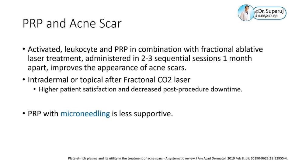 แนะนำเทคนิคดูแลหลุมสิว ep. 12 เกล็ดเลือดเข้มข้น Platelet-rich plasma (PRP)ในการดูแลรักษาหลุมสิว PRP in Acne Scar Treatment (อย่างละเอียดครับ) แนะนำเทคนิคดูแลหลุมสิว ep. 12 เกล็ดเลือดเข้มข้น Platelet-rich plasma (PRP)ในการดูแลรักษาหลุมสิว PRP in Acne Scar Treatment (อย่างละเอียดครับ)