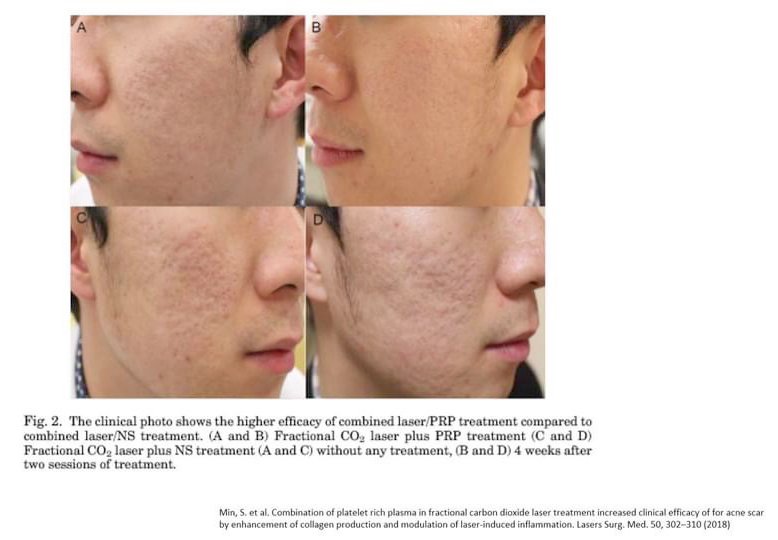 แนะนำเทคนิคดูแลหลุมสิว ep. 12 เกล็ดเลือดเข้มข้น Platelet-rich plasma (PRP)ในการดูแลรักษาหลุมสิว PRP in Acne Scar Treatment (อย่างละเอียดครับ) แนะนำเทคนิคดูแลหลุมสิว ep. 12 เกล็ดเลือดเข้มข้น Platelet-rich plasma (PRP)ในการดูแลรักษาหลุมสิว PRP in Acne Scar Treatment (อย่างละเอียดครับ)