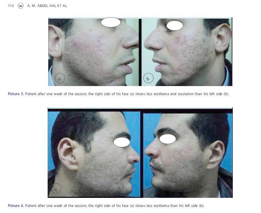 แนะนำเทคนิคดูแลหลุมสิว ep. 12 เกล็ดเลือดเข้มข้น Platelet-rich plasma (PRP)ในการดูแลรักษาหลุมสิว PRP in Acne Scar Treatment (อย่างละเอียดครับ) แนะนำเทคนิคดูแลหลุมสิว ep. 12 เกล็ดเลือดเข้มข้น Platelet-rich plasma (PRP)ในการดูแลรักษาหลุมสิว PRP in Acne Scar Treatment (อย่างละเอียดครับ)