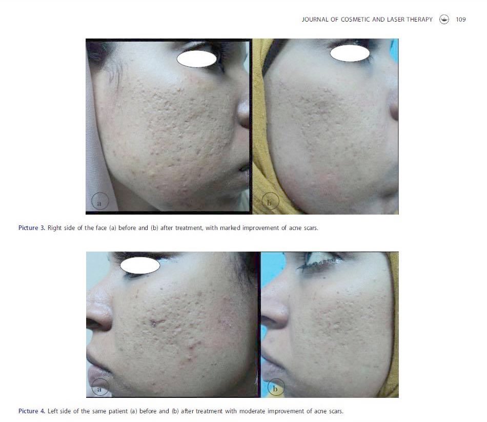 แนะนำเทคนิคดูแลหลุมสิว ep. 12 เกล็ดเลือดเข้มข้น Platelet-rich plasma (PRP)ในการดูแลรักษาหลุมสิว PRP in Acne Scar Treatment (อย่างละเอียดครับ) แนะนำเทคนิคดูแลหลุมสิว ep. 12 เกล็ดเลือดเข้มข้น Platelet-rich plasma (PRP)ในการดูแลรักษาหลุมสิว PRP in Acne Scar Treatment (อย่างละเอียดครับ)