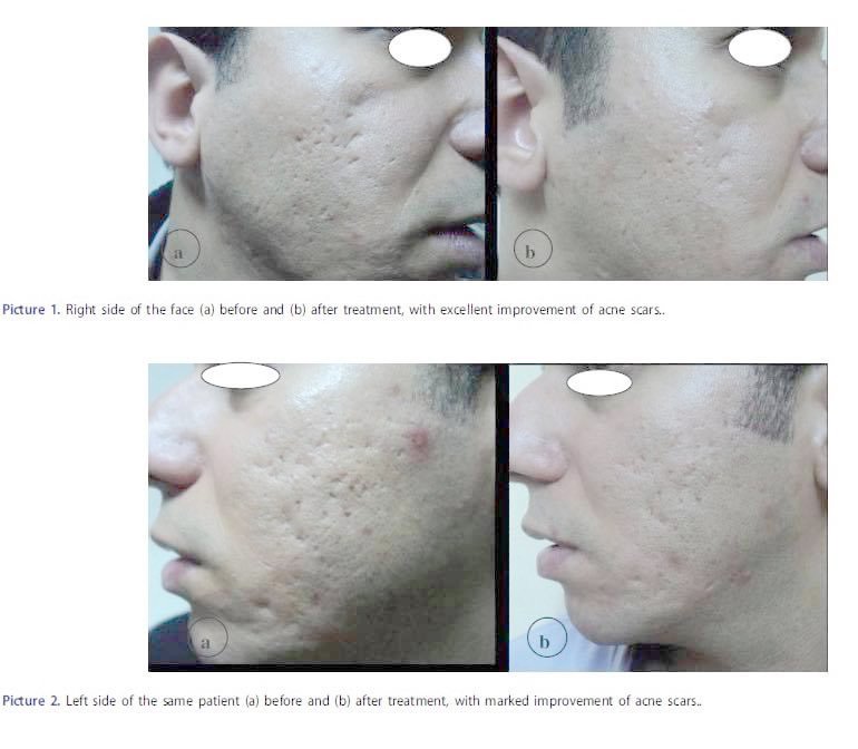 แนะนำเทคนิคดูแลหลุมสิว ep. 12 เกล็ดเลือดเข้มข้น Platelet-rich plasma (PRP)ในการดูแลรักษาหลุมสิว PRP in Acne Scar Treatment (อย่างละเอียดครับ) แนะนำเทคนิคดูแลหลุมสิว ep. 12 เกล็ดเลือดเข้มข้น Platelet-rich plasma (PRP)ในการดูแลรักษาหลุมสิว PRP in Acne Scar Treatment (อย่างละเอียดครับ)