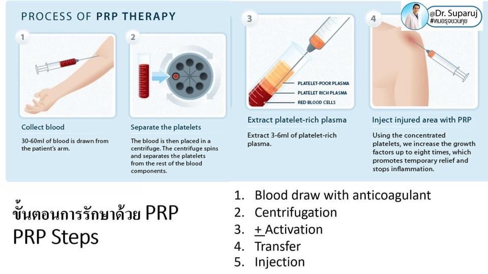 แนะนำเทคนิคดูแลหลุมสิว ep. 12 เกล็ดเลือดเข้มข้น Platelet-rich plasma (PRP)ในการดูแลรักษาหลุมสิว PRP in Acne Scar Treatment (อย่างละเอียดครับ) แนะนำเทคนิคดูแลหลุมสิว ep. 12 เกล็ดเลือดเข้มข้น Platelet-rich plasma (PRP)ในการดูแลรักษาหลุมสิว PRP in Acne Scar Treatment (อย่างละเอียดครับ)