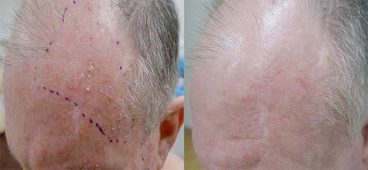 ผื่นแอกทินิกเคอราโทซิส (Actinic keratosis, AK) ผื่นแอกทินิกเคอราโทซิส (Actinic keratosis, AK)