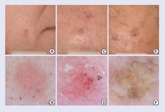 ผื่นแอกทินิกเคอราโทซิส (Actinic keratosis, AK)