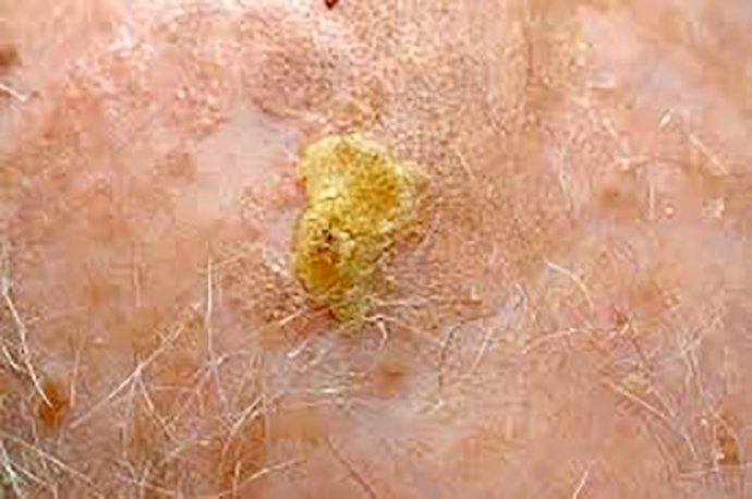 ผื่นแอกทินิกเคอราโทซิส (Actinic keratosis, AK) ผื่นแอกทินิกเคอราโทซิส (Actinic keratosis, AK)