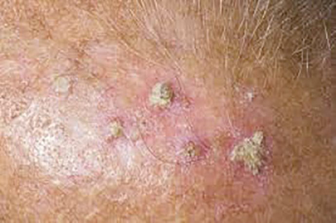 ผื่นแอกทินิกเคอราโทซิส (Actinic keratosis, AK) ผื่นแอกทินิกเคอราโทซิส (Actinic keratosis, AK)