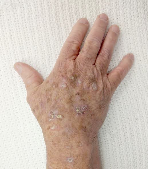 ผื่นแอกทินิกเคอราโทซิส (Actinic keratosis, AK)