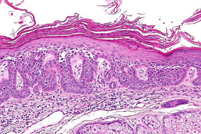 ผื่นแอกทินิกเคอราโทซิส (Actinic keratosis, AK) ผื่นแอกทินิกเคอราโทซิส (Actinic keratosis, AK)