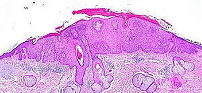 ผื่นแอกทินิกเคอราโทซิส (Actinic keratosis, AK) ผื่นแอกทินิกเคอราโทซิส (Actinic keratosis, AK)