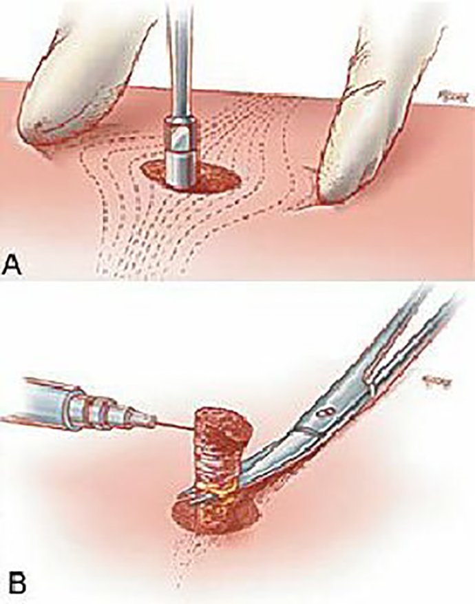 แนะนำเทคนิคดูแลหลุมสิว ep. 16 ดูแลหลุมสิวลึก Ice Pick Scar ด้วยเทคนิคผ่าตัดหลุมสิว Acne Scar Revision: Punch Excision + เลเซอร์ MultiMode Picosecond Laser แนะนำเทคนิคดูแลหลุมสิว ep. 16 ดูแลหลุมสิวลึก Ice Pick Scar ด้วยเทคนิคผ่าตัดหลุมสิว Acne Scar Revision: Punch Excision + เลเซอร์ MultiMode Picosecond Laser