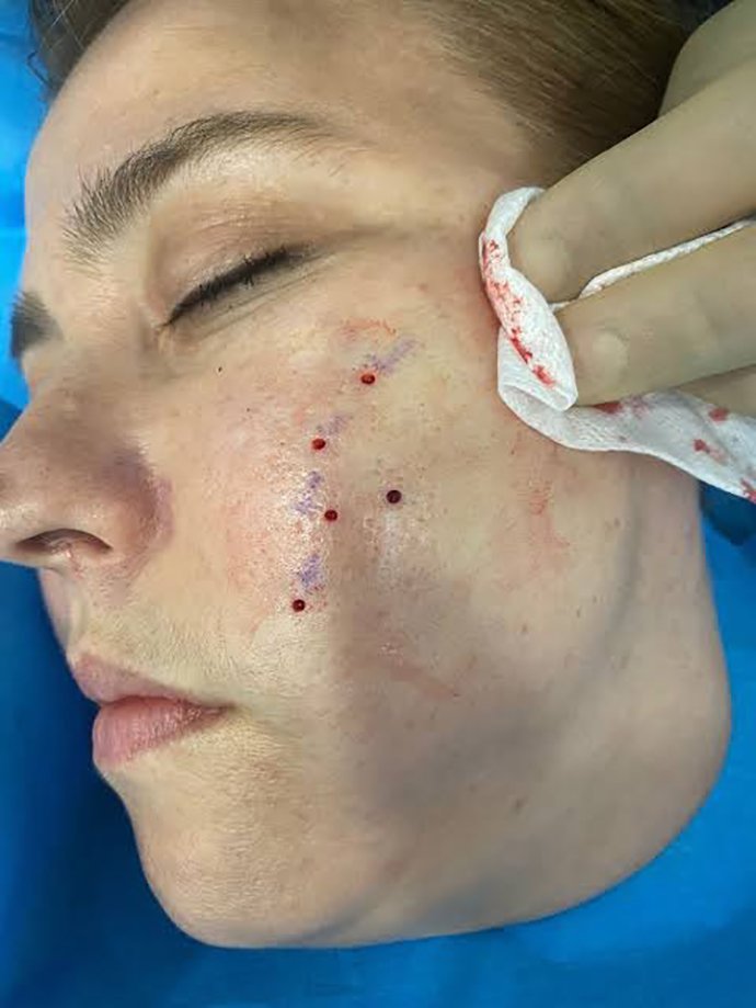 แนะนำเทคนิคดูแลหลุมสิว ep. 16 ดูแลหลุมสิวลึก Ice Pick Scar ด้วยเทคนิคผ่าตัดหลุมสิว Acne Scar Revision: Punch Excision + เลเซอร์ MultiMode Picosecond Laser แนะนำเทคนิคดูแลหลุมสิว ep. 16 ดูแลหลุมสิวลึก Ice Pick Scar ด้วยเทคนิคผ่าตัดหลุมสิว Acne Scar Revision: Punch Excision + เลเซอร์ MultiMode Picosecond Laser