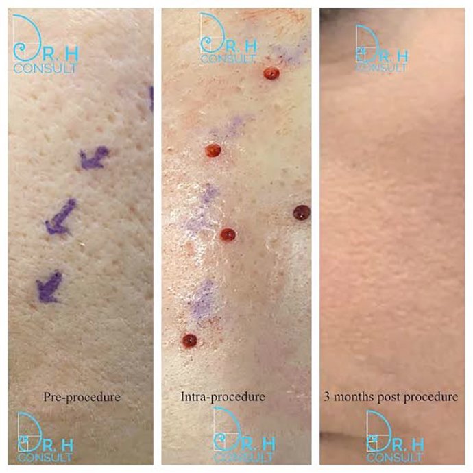 แนะนำเทคนิคดูแลหลุมสิว ep. 16 ดูแลหลุมสิวลึก Ice Pick Scar ด้วยเทคนิคผ่าตัดหลุมสิว Acne Scar Revision: Punch Excision + เลเซอร์ MultiMode Picosecond Laser แนะนำเทคนิคดูแลหลุมสิว ep. 16 ดูแลหลุมสิวลึก Ice Pick Scar ด้วยเทคนิคผ่าตัดหลุมสิว Acne Scar Revision: Punch Excision + เลเซอร์ MultiMode Picosecond Laser