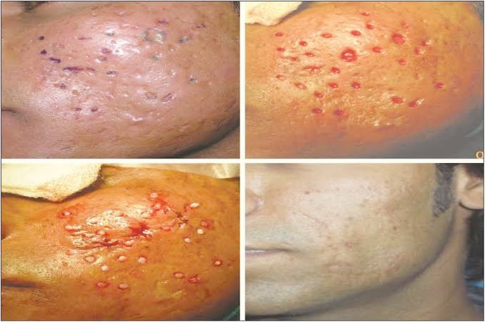 แนะนำเทคนิคดูแลหลุมสิว ep. 16 ดูแลหลุมสิวลึก Ice Pick Scar ด้วยเทคนิคผ่าตัดหลุมสิว Acne Scar Revision: Punch Excision + เลเซอร์ MultiMode Picosecond Laser แนะนำเทคนิคดูแลหลุมสิว ep. 16 ดูแลหลุมสิวลึก Ice Pick Scar ด้วยเทคนิคผ่าตัดหลุมสิว Acne Scar Revision: Punch Excision + เลเซอร์ MultiMode Picosecond Laser