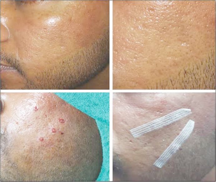 แนะนำเทคนิคดูแลหลุมสิว ep. 16 ดูแลหลุมสิวลึก Ice Pick Scar ด้วยเทคนิคผ่าตัดหลุมสิว Acne Scar Revision: Punch Excision + เลเซอร์ MultiMode Picosecond Laser แนะนำเทคนิคดูแลหลุมสิว ep. 16 ดูแลหลุมสิวลึก Ice Pick Scar ด้วยเทคนิคผ่าตัดหลุมสิว Acne Scar Revision: Punch Excision + เลเซอร์ MultiMode Picosecond Laser