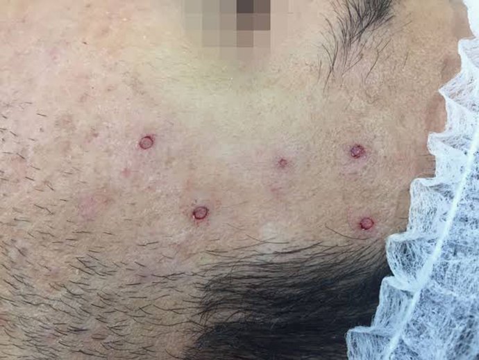 แนะนำเทคนิคดูแลหลุมสิว ep. 16 ดูแลหลุมสิวลึก Ice Pick Scar ด้วยเทคนิคผ่าตัดหลุมสิว Acne Scar Revision: Punch Excision + เลเซอร์ MultiMode Picosecond Laser แนะนำเทคนิคดูแลหลุมสิว ep. 16 ดูแลหลุมสิวลึก Ice Pick Scar ด้วยเทคนิคผ่าตัดหลุมสิว Acne Scar Revision: Punch Excision + เลเซอร์ MultiMode Picosecond Laser