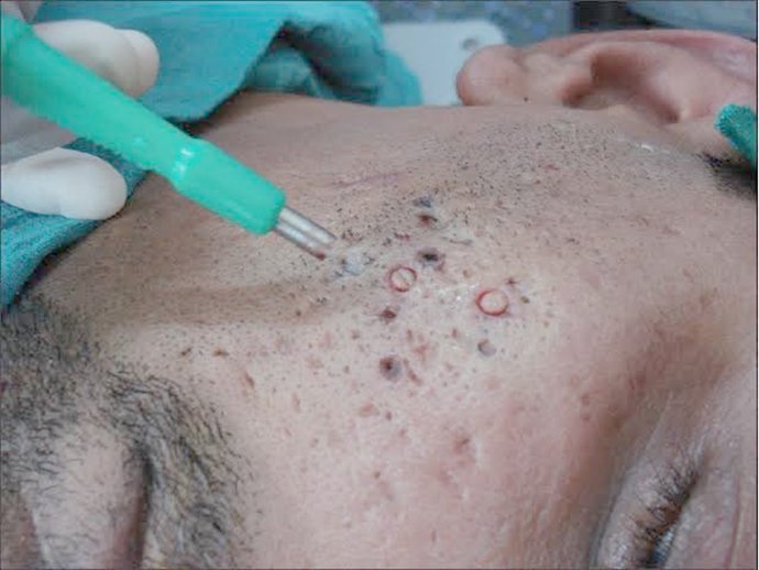 แนะนำเทคนิคดูแลหลุมสิว ep. 16 ดูแลหลุมสิวลึก Ice Pick Scar ด้วยเทคนิคผ่าตัดหลุมสิว Acne Scar Revision: Punch Excision + เลเซอร์ MultiMode Picosecond Laser แนะนำเทคนิคดูแลหลุมสิว ep. 16 ดูแลหลุมสิวลึก Ice Pick Scar ด้วยเทคนิคผ่าตัดหลุมสิว Acne Scar Revision: Punch Excision + เลเซอร์ MultiMode Picosecond Laser