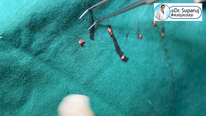 แนะนำเทคนิคดูแลหลุมสิว ep. 16 ดูแลหลุมสิวลึก Ice Pick Scar ด้วยเทคนิคผ่าตัดหลุมสิว Acne Scar Revision: Punch Excision + เลเซอร์ MultiMode Picosecond Laser แนะนำเทคนิคดูแลหลุมสิว ep. 16 ดูแลหลุมสิวลึก Ice Pick Scar ด้วยเทคนิคผ่าตัดหลุมสิว Acne Scar Revision: Punch Excision + เลเซอร์ MultiMode Picosecond Laser