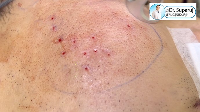 แนะนำเทคนิคดูแลหลุมสิว ep. 16 ดูแลหลุมสิวลึก Ice Pick Scar ด้วยเทคนิคผ่าตัดหลุมสิว Acne Scar Revision: Punch Excision + เลเซอร์ MultiMode Picosecond Laser