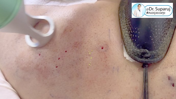 แนะนำเทคนิคดูแลหลุมสิว ep. 16 ดูแลหลุมสิวลึก Ice Pick Scar ด้วยเทคนิคผ่าตัดหลุมสิว Acne Scar Revision: Punch Excision + เลเซอร์ MultiMode Picosecond Laser แนะนำเทคนิคดูแลหลุมสิว ep. 16 ดูแลหลุมสิวลึก Ice Pick Scar ด้วยเทคนิคผ่าตัดหลุมสิว Acne Scar Revision: Punch Excision + เลเซอร์ MultiMode Picosecond Laser