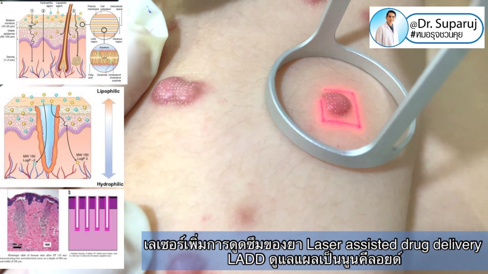 การใช้เลเซอร์เพิ่มการดูดซึมของยา Laser assisted drug delivery LADD ในการดูแลแผลเป็นนูนคีลอยด์ การใช้เลเซอร์เพิ่มการดูดซึมของยา Laser assisted drug delivery LADD ในการดูแลแผลเป็นนูนคีลอยด์