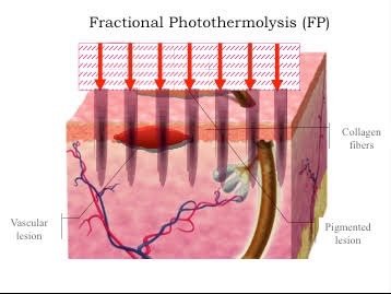 การใช้เลเซอร์เพิ่มการดูดซึมของยา Laser assisted drug delivery LADD ในการดูแลแผลเป็นนูนคีลอยด์ การใช้เลเซอร์เพิ่มการดูดซึมของยา Laser assisted drug delivery LADD ในการดูแลแผลเป็นนูนคีลอยด์