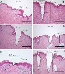 การใช้เลเซอร์เพิ่มการดูดซึมของยา Laser assisted drug delivery LADD ในการดูแลแผลเป็นนูนคีลอยด์ การใช้เลเซอร์เพิ่มการดูดซึมของยา Laser assisted drug delivery LADD ในการดูแลแผลเป็นนูนคีลอยด์
