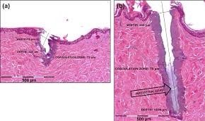 การใช้เลเซอร์เพิ่มการดูดซึมของยา Laser assisted drug delivery LADD ในการดูแลแผลเป็นนูนคีลอยด์ การใช้เลเซอร์เพิ่มการดูดซึมของยา Laser assisted drug delivery LADD ในการดูแลแผลเป็นนูนคีลอยด์