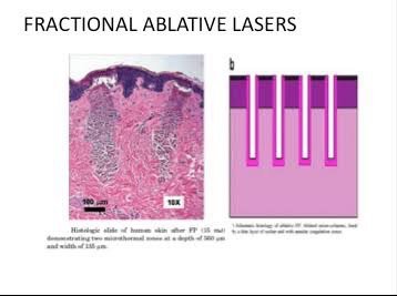 การใช้เลเซอร์เพิ่มการดูดซึมของยา Laser assisted drug delivery LADD ในการดูแลแผลเป็นนูนคีลอยด์