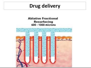 การใช้เลเซอร์เพิ่มการดูดซึมของยา Laser assisted drug delivery LADD ในการดูแลแผลเป็นนูนคีลอยด์