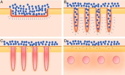 การใช้เลเซอร์เพิ่มการดูดซึมของยา Laser assisted drug delivery LADD ในการดูแลแผลเป็นนูนคีลอยด์ การใช้เลเซอร์เพิ่มการดูดซึมของยา Laser assisted drug delivery LADD ในการดูแลแผลเป็นนูนคีลอยด์
