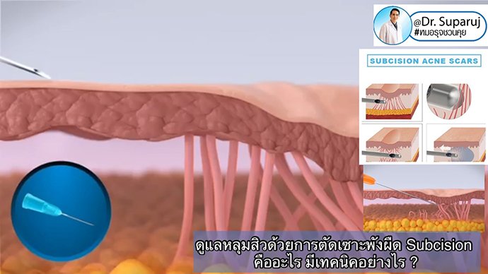 ดูแลหลุมสิวด้วยการตัดเซาะพังผืด Acne Scar Subcision คืออะไร มีเทคนิคอย่างไร ? ดูแลหลุมสิวด้วยการตัดเซาะพังผืด Acne Scar Subcision คืออะไร มีเทคนิคอย่างไร ?