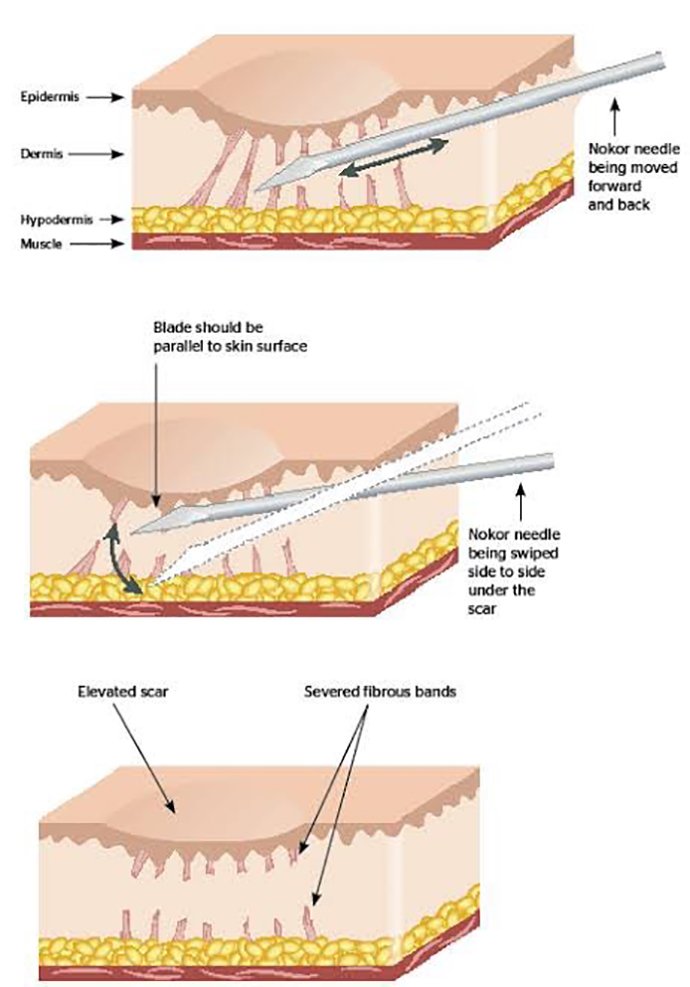 ดูแลหลุมสิวด้วยการตัดเซาะพังผืด Acne Scar Subcision คืออะไร มีเทคนิคอย่างไร ? ดูแลหลุมสิวด้วยการตัดเซาะพังผืด Acne Scar Subcision คืออะไร มีเทคนิคอย่างไร ?