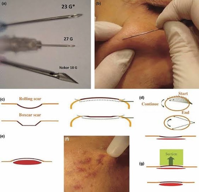 ดูแลหลุมสิวด้วยการตัดเซาะพังผืด Acne Scar Subcision คืออะไร มีเทคนิคอย่างไร ? ดูแลหลุมสิวด้วยการตัดเซาะพังผืด Acne Scar Subcision คืออะไร มีเทคนิคอย่างไร ?