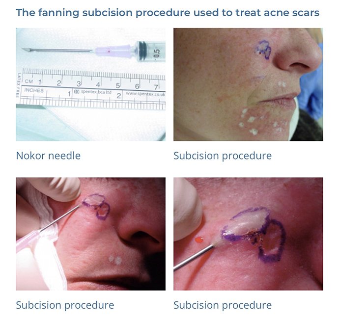 ดูแลหลุมสิวด้วยการตัดเซาะพังผืด Acne Scar Subcision คืออะไร มีเทคนิคอย่างไร ? ดูแลหลุมสิวด้วยการตัดเซาะพังผืด Acne Scar Subcision คืออะไร มีเทคนิคอย่างไร ?
