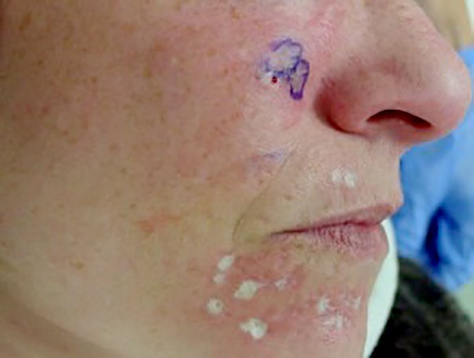 ดูแลหลุมสิวด้วยการตัดเซาะพังผืด Acne Scar Subcision คืออะไร มีเทคนิคอย่างไร ? ดูแลหลุมสิวด้วยการตัดเซาะพังผืด Acne Scar Subcision คืออะไร มีเทคนิคอย่างไร ?