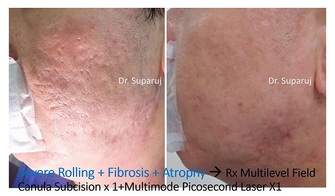 ดูแลหลุมสิวด้วยการตัดเซาะพังผืด Acne Scar Subcision คืออะไร มีเทคนิคอย่างไร ? ดูแลหลุมสิวด้วยการตัดเซาะพังผืด Acne Scar Subcision คืออะไร มีเทคนิคอย่างไร ?