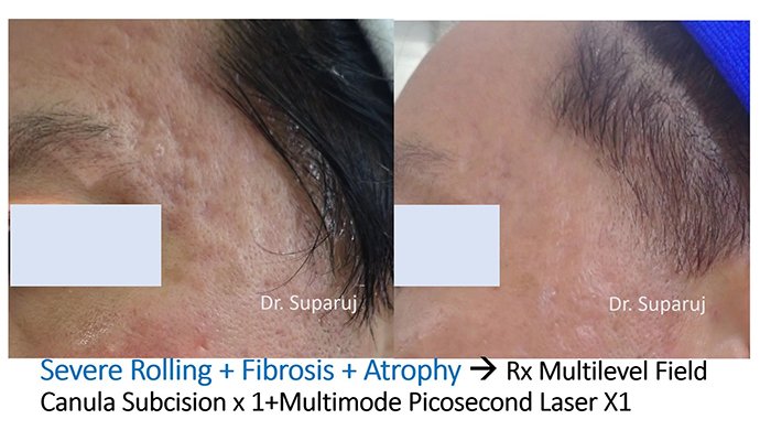 ดูแลหลุมสิวด้วยการตัดเซาะพังผืด Acne Scar Subcision คืออะไร มีเทคนิคอย่างไร ? ดูแลหลุมสิวด้วยการตัดเซาะพังผืด Acne Scar Subcision คืออะไร มีเทคนิคอย่างไร ?