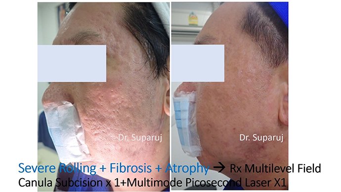 ดูแลหลุมสิวด้วยการตัดเซาะพังผืด Acne Scar Subcision คืออะไร มีเทคนิคอย่างไร ? ดูแลหลุมสิวด้วยการตัดเซาะพังผืด Acne Scar Subcision คืออะไร มีเทคนิคอย่างไร ?