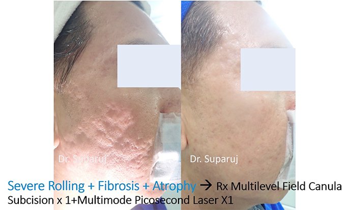 ดูแลหลุมสิวด้วยการตัดเซาะพังผืด Acne Scar Subcision คืออะไร มีเทคนิคอย่างไร ? ดูแลหลุมสิวด้วยการตัดเซาะพังผืด Acne Scar Subcision คืออะไร มีเทคนิคอย่างไร ?