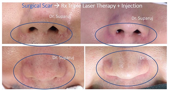 ดูแลรอยแผลผ่าตัด Surgical Scar เพื่อป้องกันการเกิดแผลเป็นนูนเกิน Hyperthrophic Scar และคีลอยด์ Keloid ดูแลรอยแผลผ่าตัด Surgical Scar เพื่อป้องกันการเกิดแผลเป็นนูนเกิน Hyperthrophic Scar และคีลอยด์ Keloid