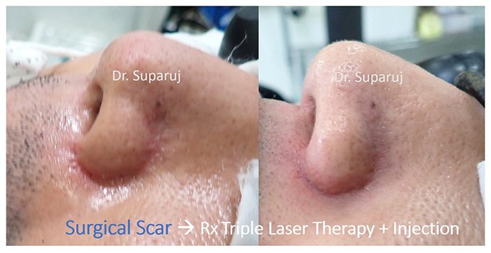 ดูแลรอยแผลผ่าตัด Surgical Scar เพื่อป้องกันการเกิดแผลเป็นนูนเกิน Hyperthrophic Scar และคีลอยด์ Keloid ดูแลรอยแผลผ่าตัด Surgical Scar เพื่อป้องกันการเกิดแผลเป็นนูนเกิน Hyperthrophic Scar และคีลอยด์ Keloid